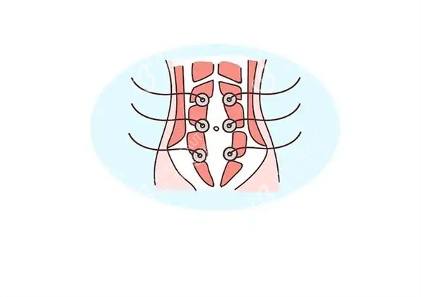 腹直肌分离图