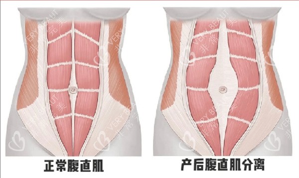 腹直肌分离