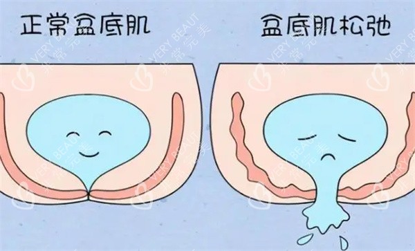 盆底肌修复图片