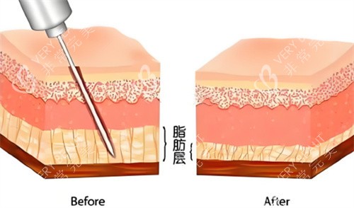 隆胸手术前后