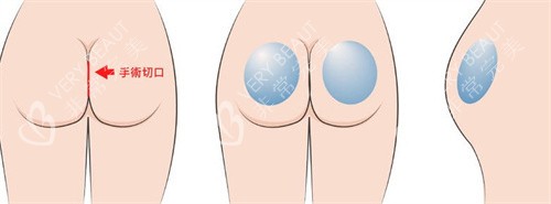 豐臀手術