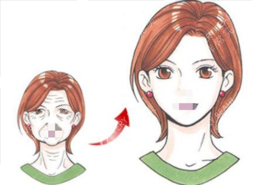 拉皮手術(shù)前后對比圖