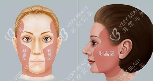 拉皮手術(shù)剝離區(qū)