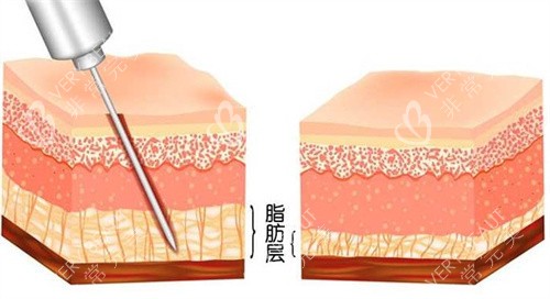 女性m型發(fā)際線卡通圖