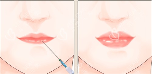注射丰唇手术