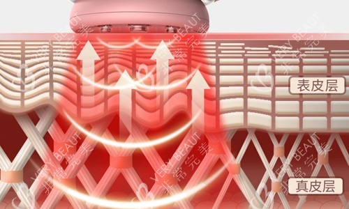 光子嫩膚激光作用展示