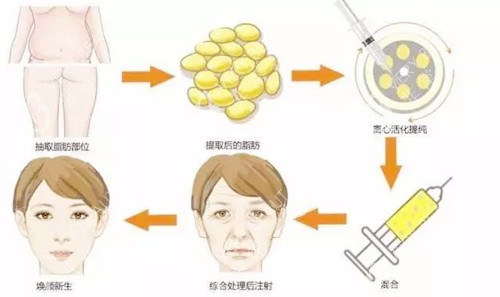王明利醫(yī)生自體脂肪面部填充