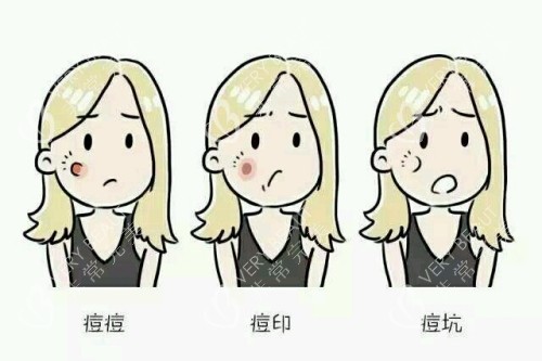 痘印痘坑卡通图