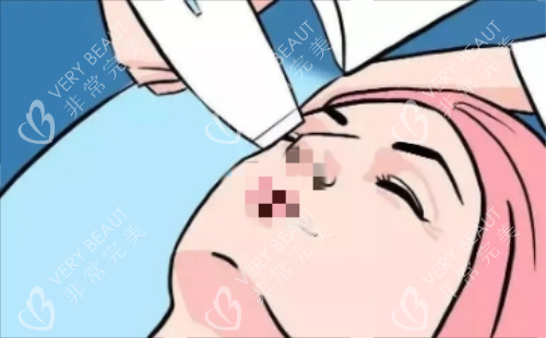激光除皱示意图