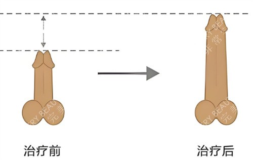 男生增大增粗示意图
