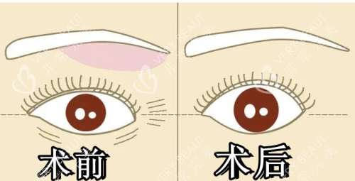 提眉术前术后对比图