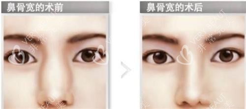 鼻骨内推前后的对比
