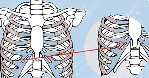 隆鼻肋骨鼻所用肋骨图