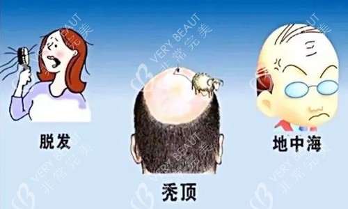 脱发图示