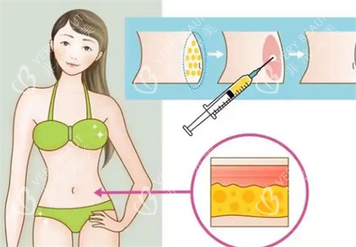吸脂手术腰部