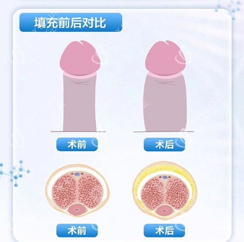 填充增大增粗示意图