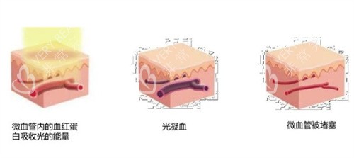 造成红血丝的几种原因