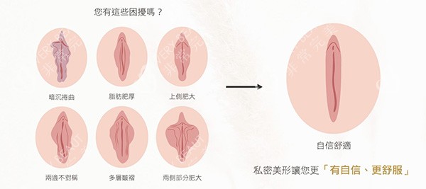 外阴阴唇整形前后变化