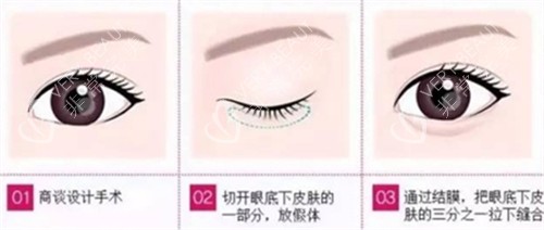 卧蚕手术步骤