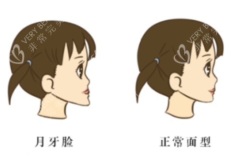 月牙脸和正常脸型前后对比图