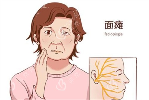 面瘫真实情况