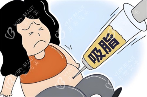 冯斌非正规吸脂术