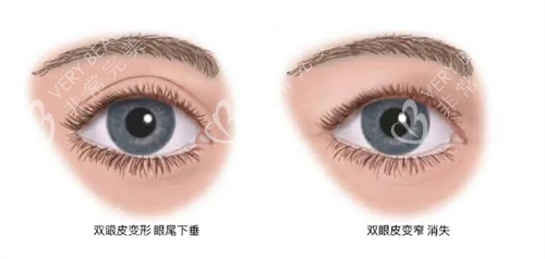 什么情况下要提眉