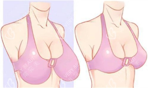 巨乳缩小术