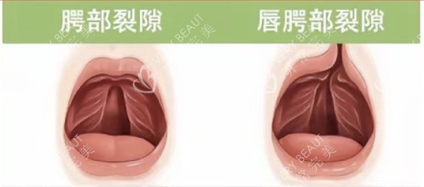 唇腭裂