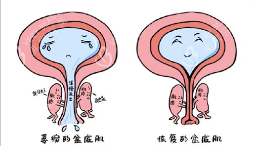 盆底肌对比