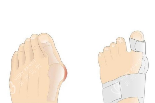 大脚骨矫正卡通图