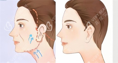 面部提拉
