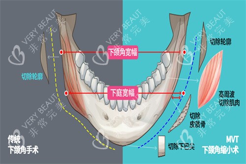 下颌角手术宣传图