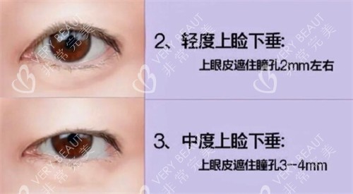 上睑下垂自测图