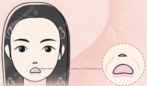 法令纹