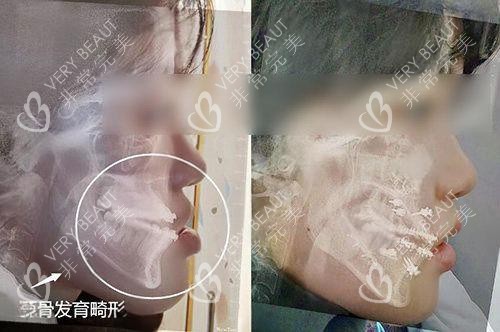 地包天正颌手术前后对比