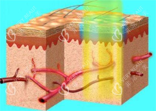 595染料激光治疗过程