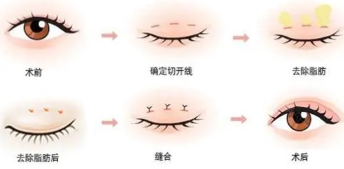 宁波海曙珐丽双眼皮手术过程图