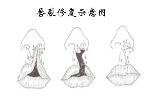 唇裂修复示意图.webp