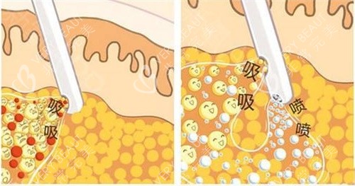 深圳孟曹君抽脂手术抽脂方式动画演示图