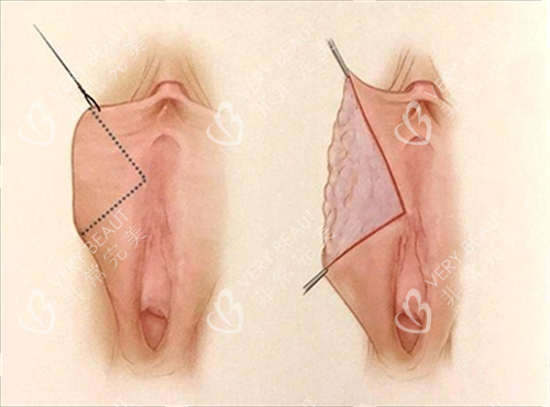 女性私密手术动画展示