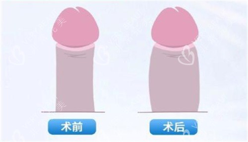 男性私密脂肪填充