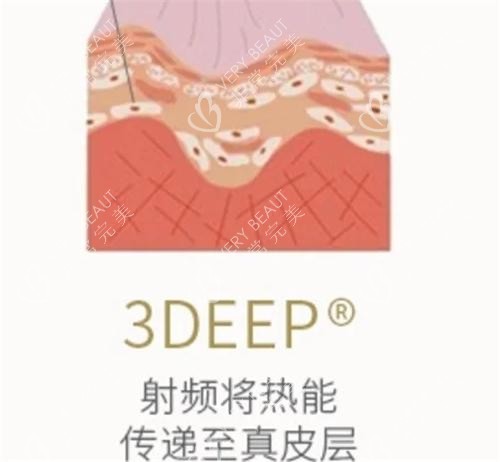 以色列3Deep相控射频作用
