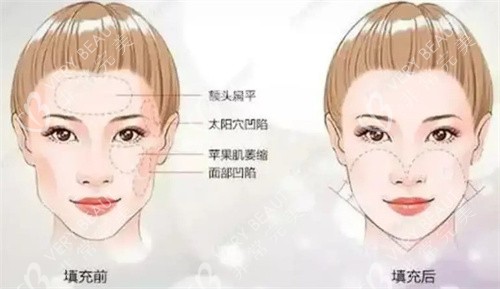 海魅云镜骨胶原填充面部可以维持多久？一般在18~24个月，附上其填充功效及费用一览-非常完美