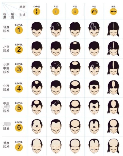 黑米3d纹发不同脱发类型
