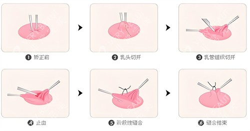 乳头内陷手术步骤图解