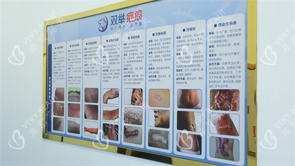 哈尔滨双举专科门诊部疤痕分类介绍