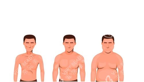 男性乳房肥大示意