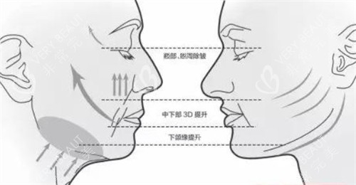 拉皮