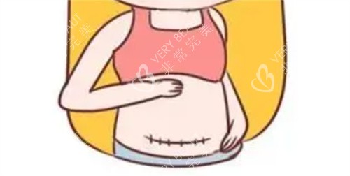 腹部疤痕